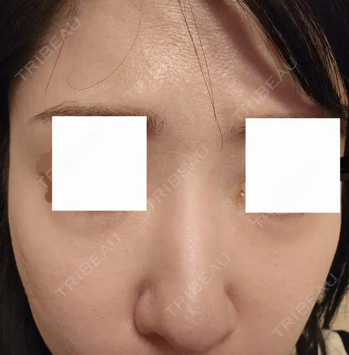 ニードルRF（ポテンツァなど） A CLINIC（エークリニック） 仙台院 BEFORE メイン用