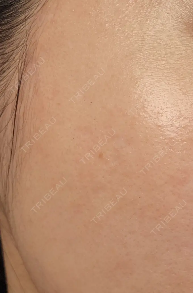 シミ取りレーザー 湘南美容クリニック 仙台院 BEFORE メイン用