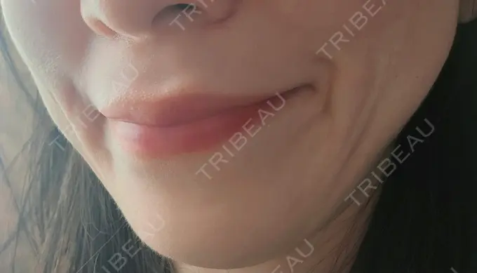 ショッピングリフト 湘南美容クリニック 仙台院 BEFORE メイン用