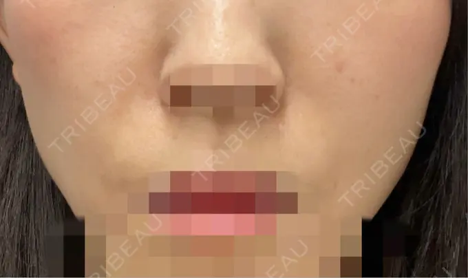 ヒアルロン酸注入（鼻翼基部） BiBiクリニック BEFORE メイン用