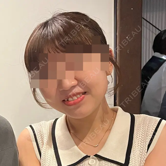 糸リフト / 脂肪吸引（顔） / 脂肪吸引注射（顔） ziz CLINIC BEFORE メイン用