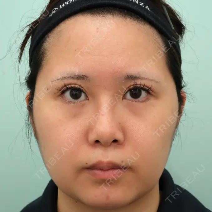 目尻切開 / 脂肪注入（目の下） / その他（目元） WOM CLINIC GINZA （ワム クリニック ギンザ） BEFORE メイン用