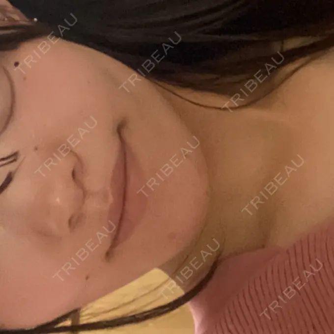 ボトックス（エラ・小顔） TCB東京中央美容外科 郡山院 BEFORE メイン用