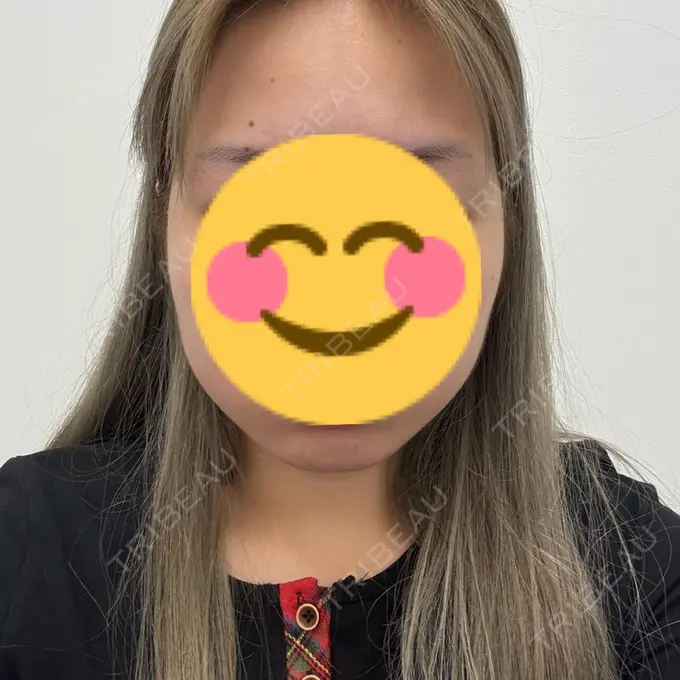 ボトックス（エラ・小顔） TCB東京中央美容外科 札幌駅前院 BEFORE メイン用