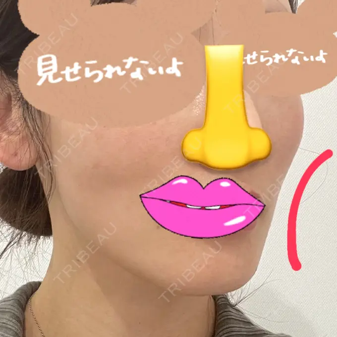 ヒアルロン酸注入（頬） ジョウクリニック 大阪院 BEFORE メイン用