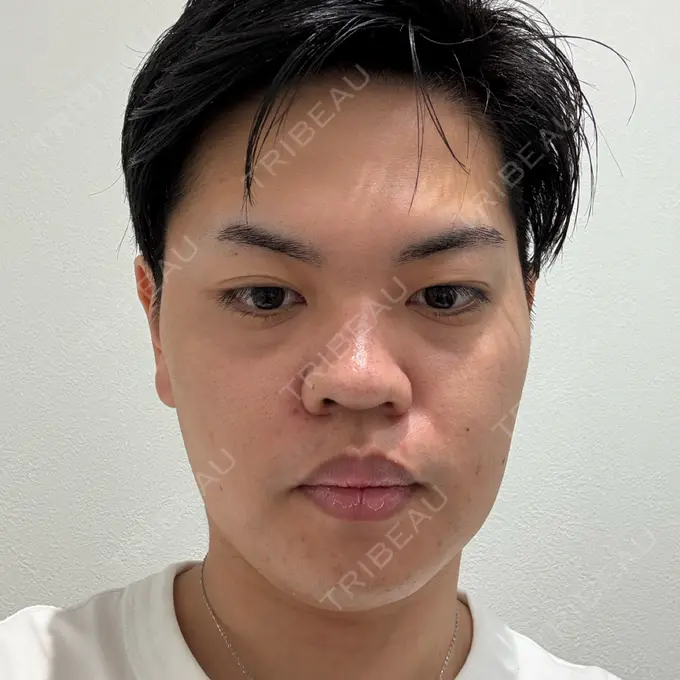 ピーリング（ニキビ・毛穴） First Clinic BEFORE メイン用