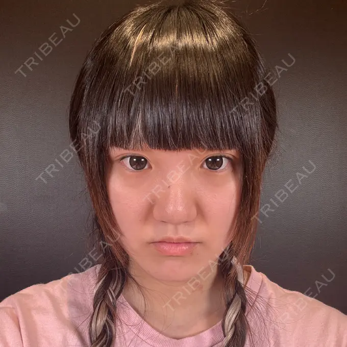 鼻中隔延長（切開） / 小鼻縮小（切開） / 鼻孔縁挙上 / 鼻翼基部形成（貴族手術） / その他（目元） R Beauty CLINIC 銀座院 BEFORE メイン用