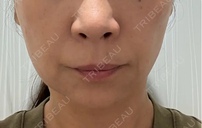 RF（高周波）たるみ治療 ゆきスキンクリニック 東池袋 BEFORE メイン用