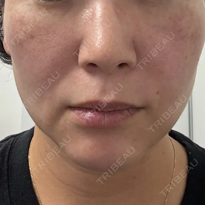 肌ヒアルロン酸注入（たるみ・シワ改善） / 毛穴洗浄（ハイドラフェイシャルなど） / ピコレーザートーニング（美白・肝斑） / その他（輪郭） 東京シルククリニック 東京神田院 BEFORE メイン用