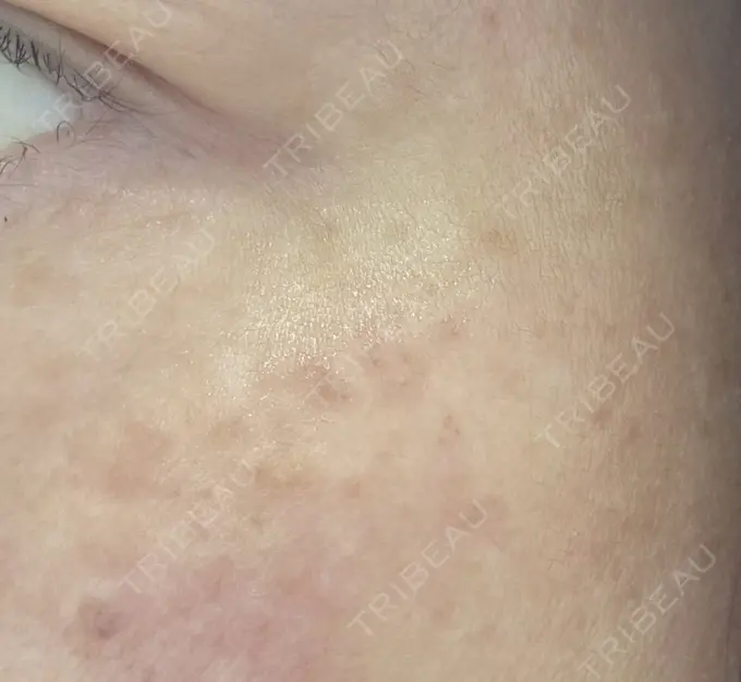 イオン導入 / ピーリング（ハリ・ツヤ） / ルメッカ ルラ美容クリニック 名古屋栄院 / ルラスキンクリニック 名古屋栄院 BEFORE メイン用