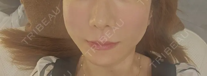 水光注射（ハリ・美肌） Chloe Cheongdam Clinic （クロエチョンダムクリニック） BEFORE メイン用