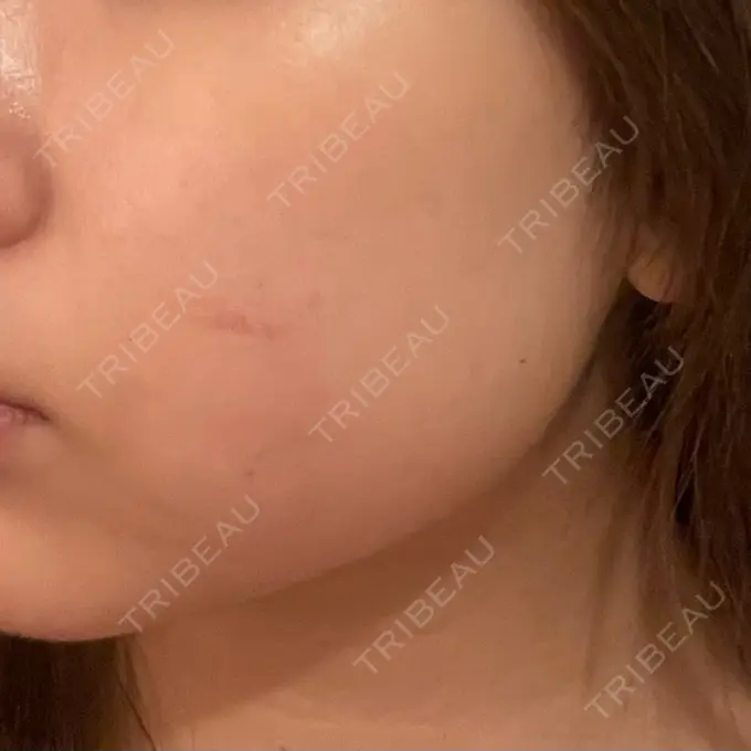 シワ取りボトックス / RF（高周波）たるみ治療 東京シルククリニック 東京神田院 BEFORE メイン用