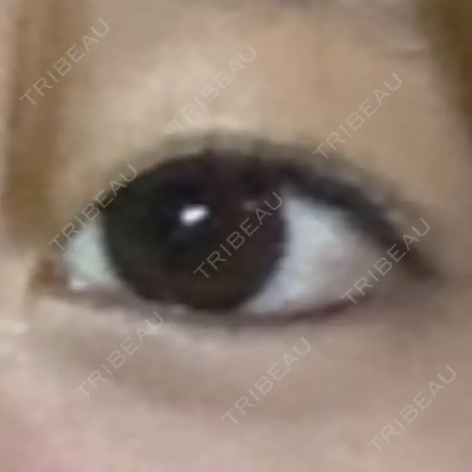 ヒアルロン酸注入（涙袋） / ボトックス（エラ・小顔） フィラークリニック 名古屋栄院 BEFORE メイン用