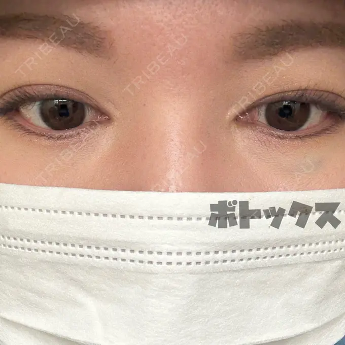 クマ治療 / ボトックス（あご） / ボトックス（口角） / ボトックス（眉間） / ボトックス（額） / ボトックス（人中） Leap beauty clinic BEFORE メイン用