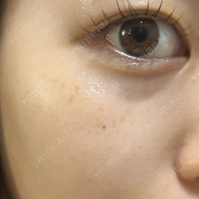 ルメッカ ゆきスキンクリニック 東池袋 BEFORE メイン用