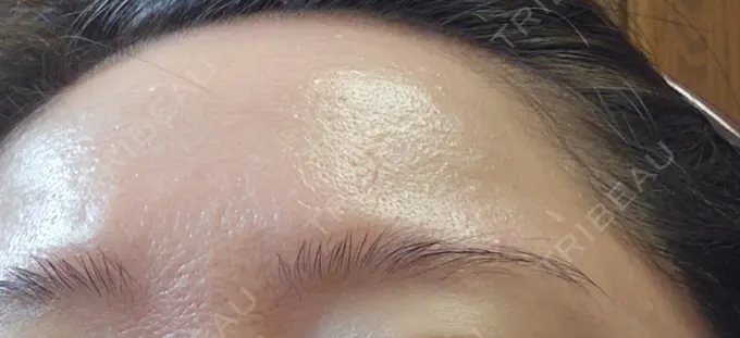 ニードルRF（ポテンツァなど） A CLINIC（エークリニック） 仙台院 BEFORE メイン用