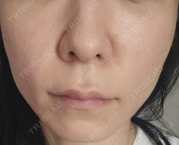 肌ヒアルロン酸注入（たるみ・シワ改善） 湘南美容皮フ科 仙台院 BEFORE メイン用