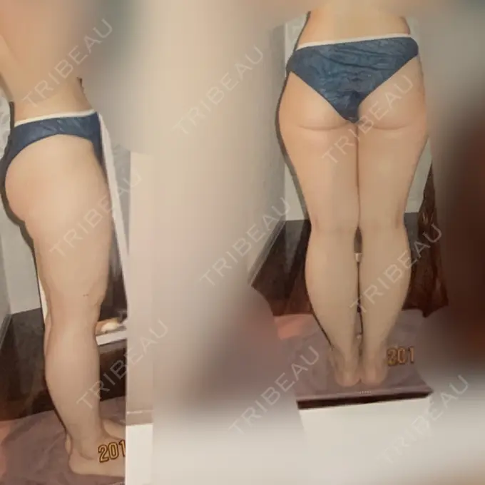 脂肪吸引（二の腕） / 脂肪吸引（脚） / 脂肪吸引（お尻） / ボトックス（ふくらはぎ） / その他（ボディ） ドクターフィット（Dr.fit）クリニック BEFORE メイン用