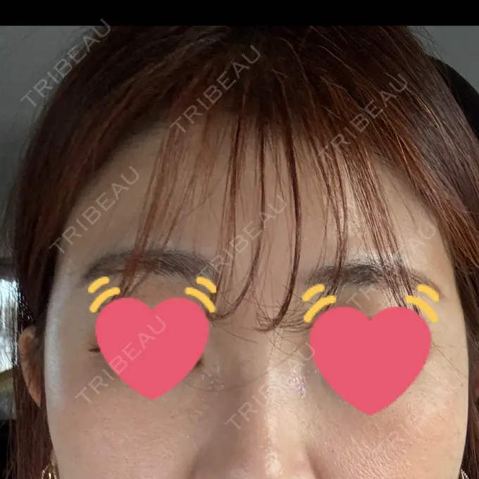 シワ取りボトックス / ボトックス（眉間） 銀座美容外科クリニック 銀座院 BEFORE メイン用