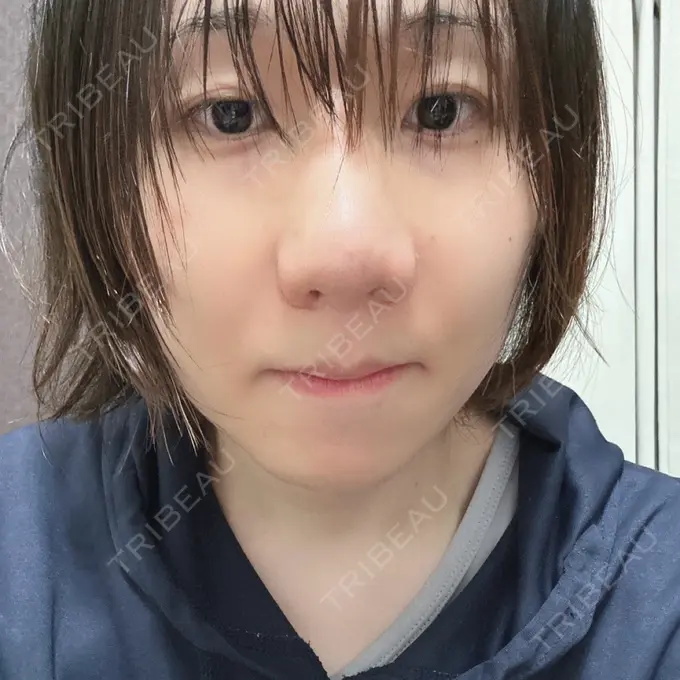 鼻尖形成（切開） / 小鼻縮小（切開） / 軟骨移植 / 骨切幅寄せ / 鼻尖縮小 id（アイディ）美容外科 BEFORE メイン用