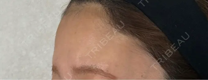 ヒアルロン酸注入（額） / ボトックス（額） アリエル美容クリニック 横浜院 BEFORE メイン用