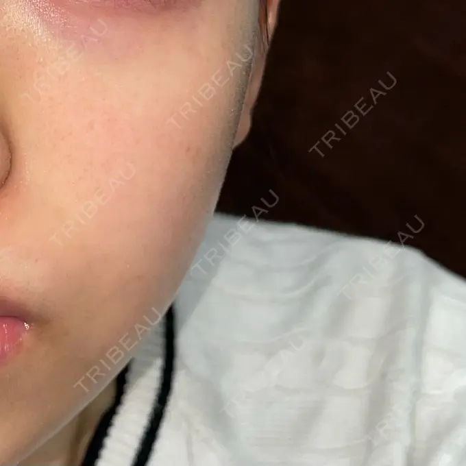 ピコレーザートーニング（美白・肝斑） おおかみ美容のクリニック 横浜院 BEFORE メイン用