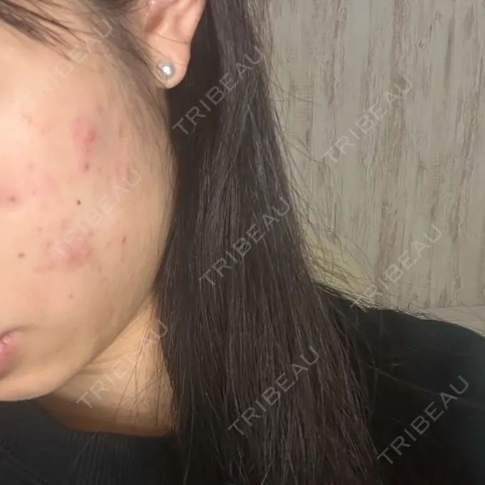 ニードルRF（ポテンツァなど） MKクリニック 日本橋院 BEFORE メイン用