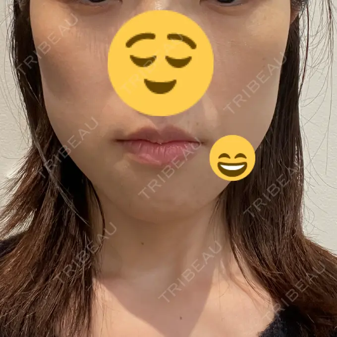 ピーリング（ニキビ・毛穴） Sea Sail Beauty Clinic BEFORE メイン用