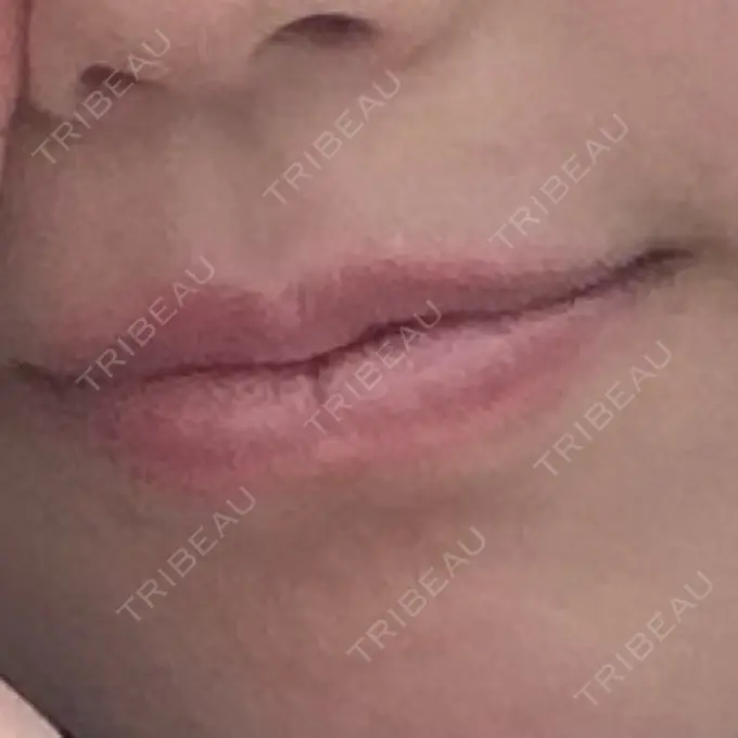 ボトックス（口角） TCB東京中央美容外科 広島院 BEFORE メイン用