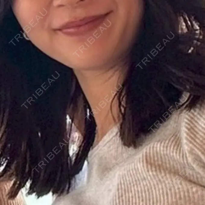 ボトックス（エラ・小顔） / ハイフ（顔） LOUIS CLINIC 二子玉川院【ルイクリニック】 BEFORE メイン用