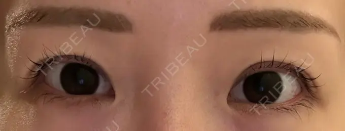 二重埋没 宇都宮竹内クリニック BEFORE メイン用