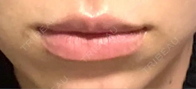 人中短縮 / 口角挙上 / ヒアルロン酸注入（唇） / その他（口元） 銀座美容外科クリニック 銀座院 BEFORE メイン用