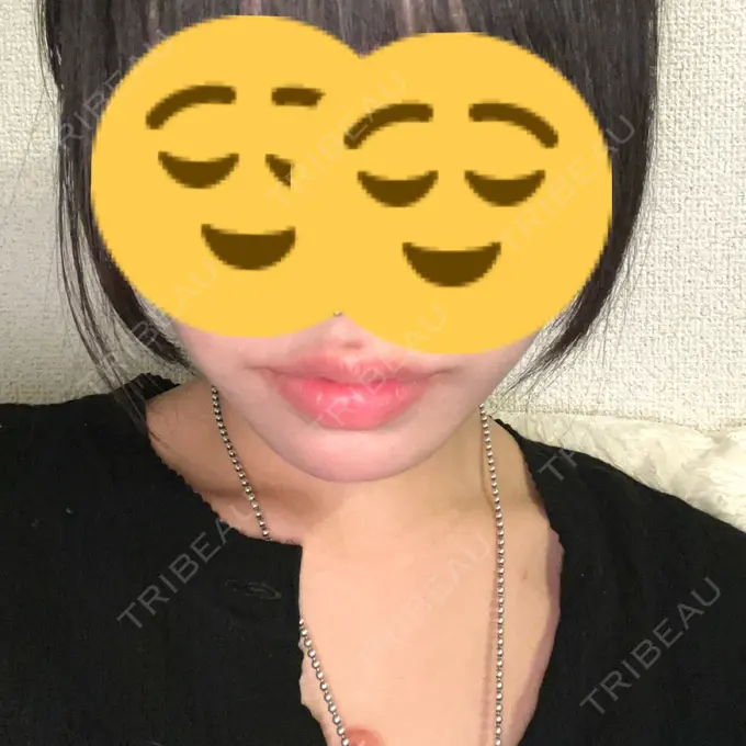 ヒアルロン酸注入（唇） / ボトックス（口角） ルラ美容クリニック 高田馬場院 BEFORE メイン用