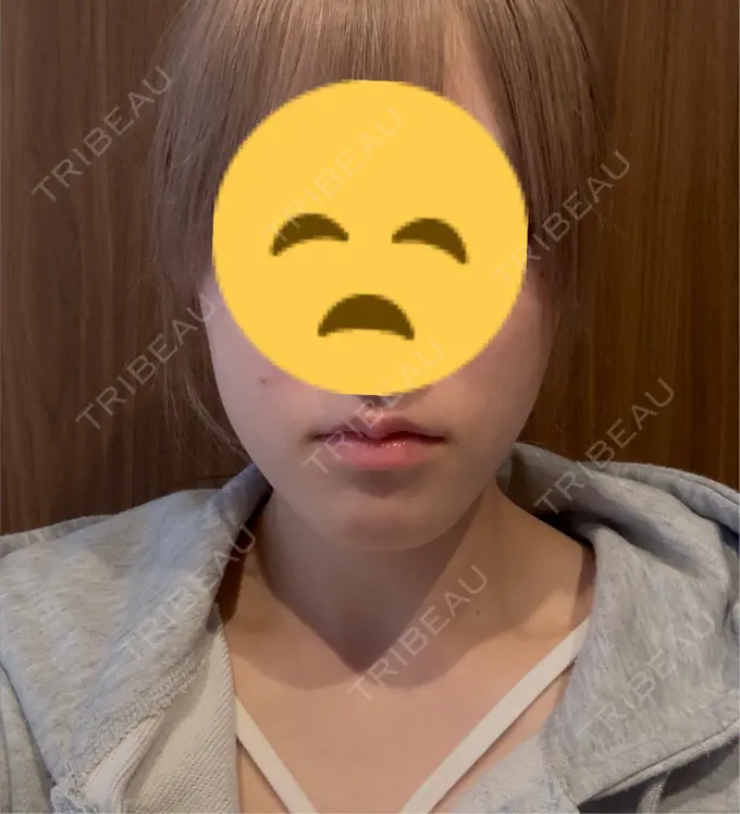 ボトックス（口角） veary clinic BEFORE メイン用