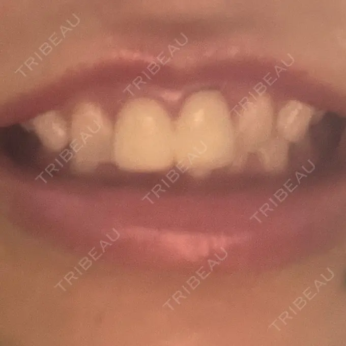 ホワイトニング 東京銀座A CLINIC デンタル BEFORE メイン用