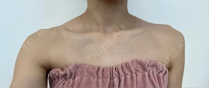 ボトックス（肩） Next Tokyo Clinic BEFORE メイン用