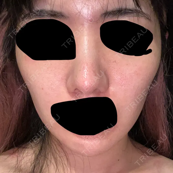 ヒアルロン酸注入（頬） THE FIRST CLINIC 町田院 BEFORE メイン用