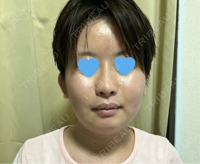 ピコレーザートーニング（美白・肝斑） 白金ビークリニック 本院 BEFORE メイン用