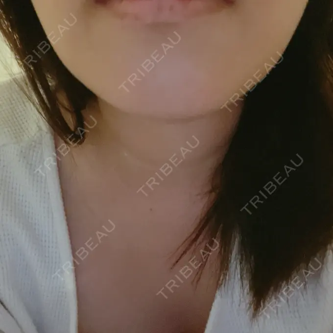 脂肪溶解注射（顔） REDLINE CLINIC BEFORE メイン用