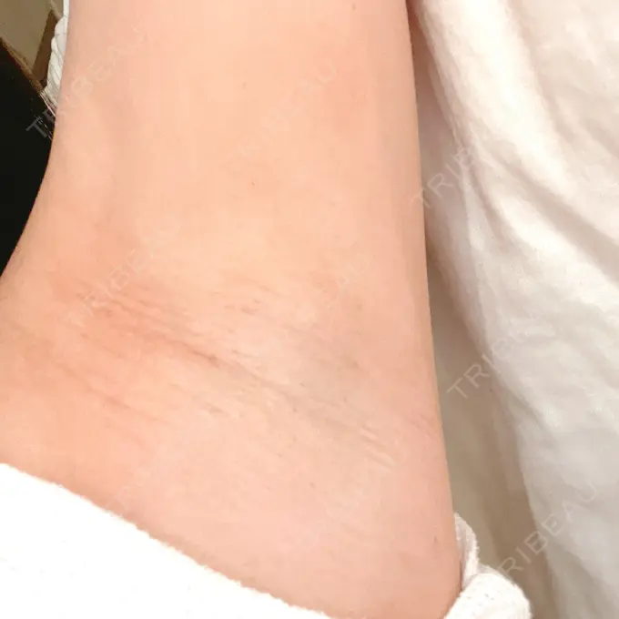 医療脱毛（ワキ） ルラ美容クリニック 神戸院 BEFORE メイン用