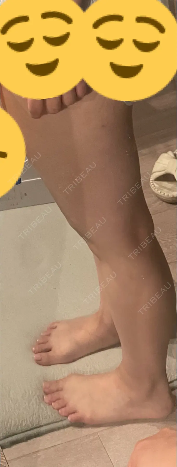 脂肪吸引（顔） / 脂肪吸引（二の腕） / 脂肪吸引（脚） / 脂肪吸引（お腹） / 脂肪吸引（お尻） / 豊胸（脂肪注入） / 脂肪吸引（腰） / 脂肪吸引（背中） / 脂肪吸引（肩） ヴェルトラクリニック 新宿院 BEFORE メイン用