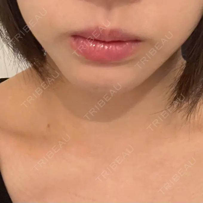 ボトックス（あご） / ヒアルロン酸注入（あご） ルラ美容クリニック 大宮院 / ルラスキンクリニック 大宮院 BEFORE メイン用