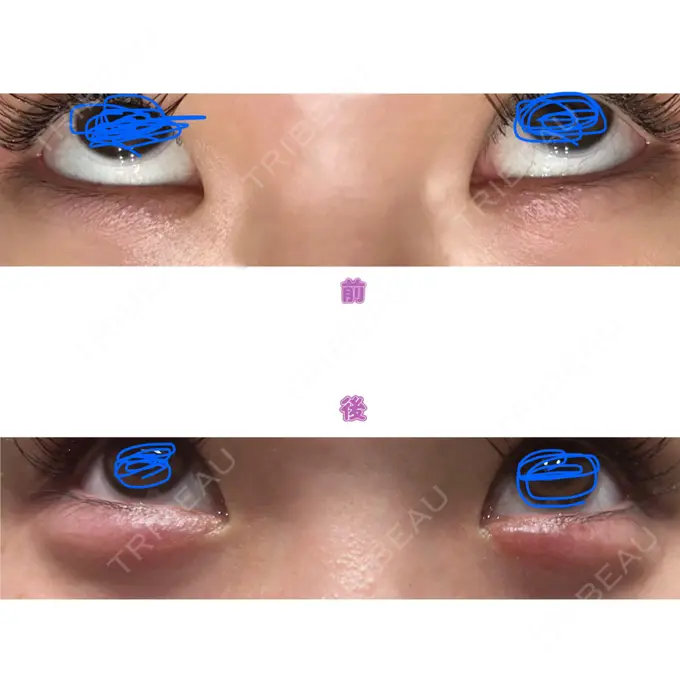 ヒアルロン酸注入（涙袋） Code Beauty Clinic 名古屋院 BEFORE メイン用