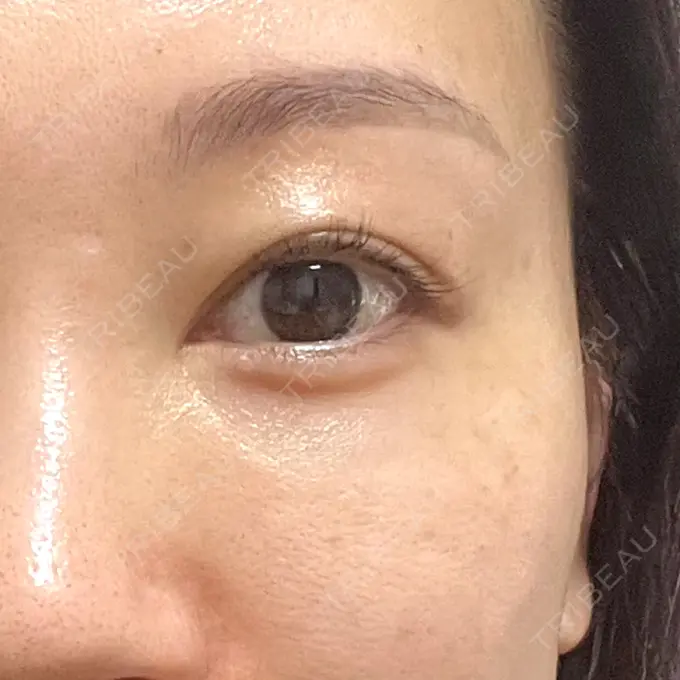 肌ヒアルロン酸注入（たるみ・シワ改善） しのぶ皮膚科 BEFORE メイン用