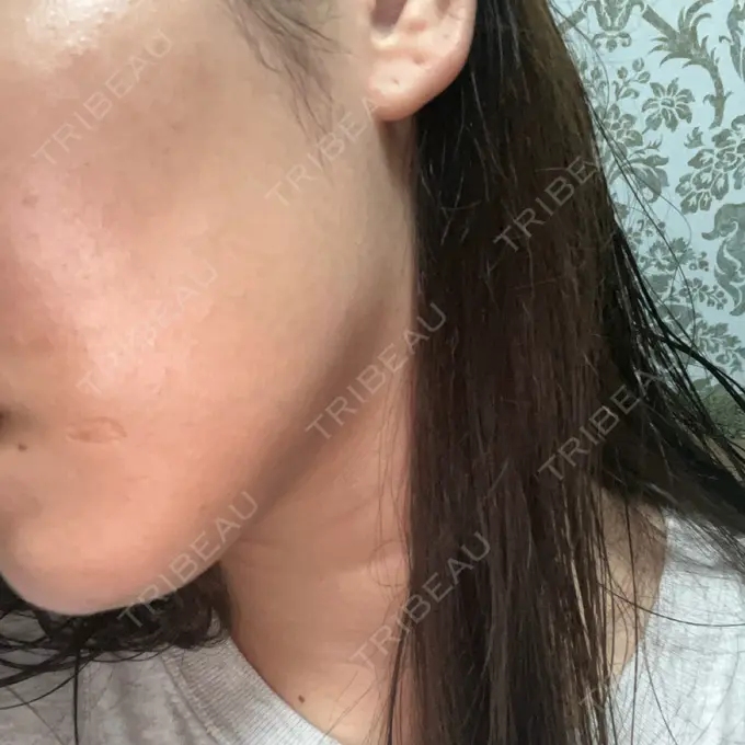 光治療（フォトフェイシャルなど） Sea Sail Beauty Clinic BEFORE メイン用