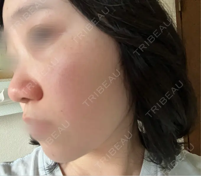 ルメッカ BITO BEAUTY CLINIC BEFORE メイン用