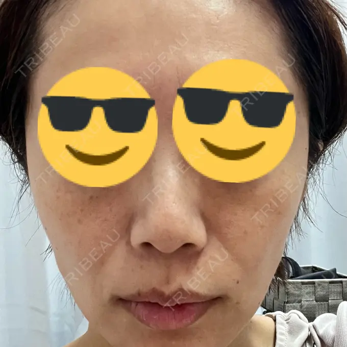 ルメッカ 東京美容外科 池袋院 BEFORE メイン用