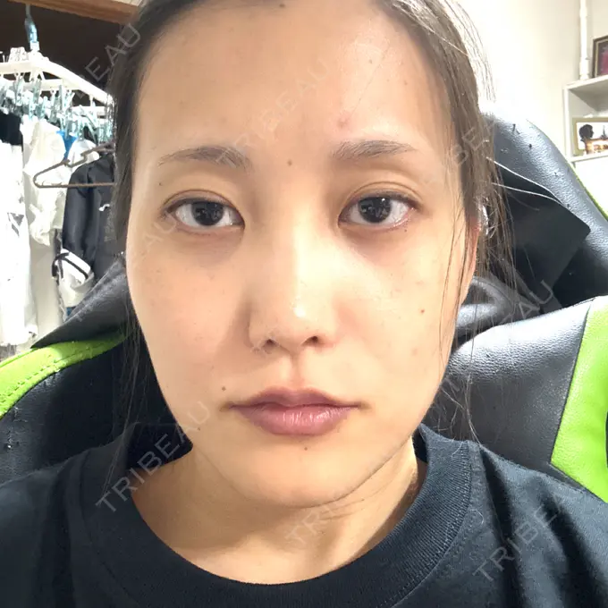 ボトックス（あご） / ヒアルロン酸注入（唇） YBC横浜美容外科 立川院 BEFORE メイン用