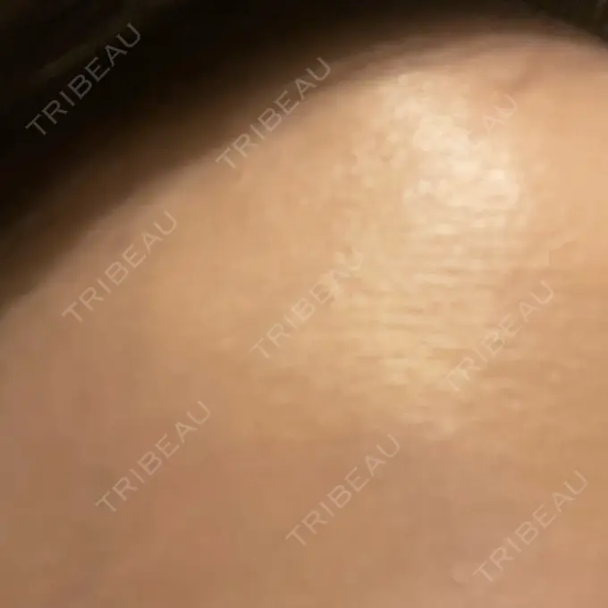 ほくろ・いぼ切除（肌） / 脂肪溶解注射（顔） 吉祥寺アイビークリニック BEFORE メイン用