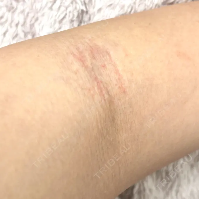 美容点滴・美容注射（美肌） / 白玉点滴・注射 城本クリニック 新宿院 BEFORE メイン用